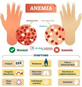 Anemia in Pregnancy