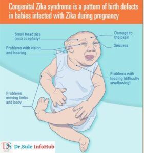 Congenital Zika Syndrome