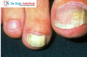 onychomycosis