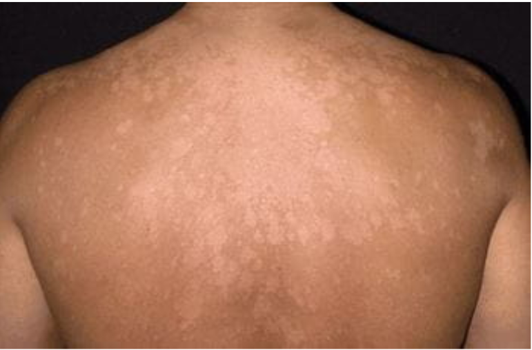 tinea vesicolor