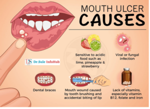 Causes of mouth Ulcer