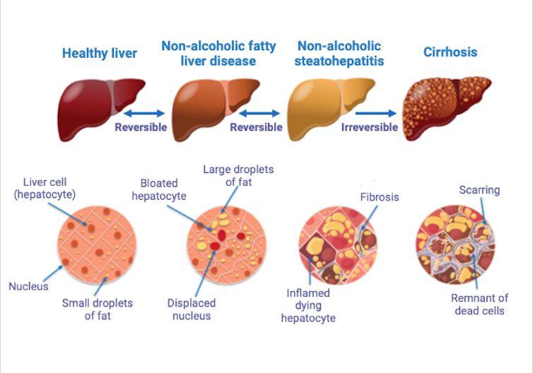 Fatty Liver disease