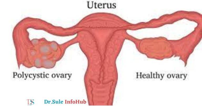 Diagnosis of PCOD vs. PCOS