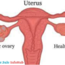 Diagnosis of PCOD vs. PCOS