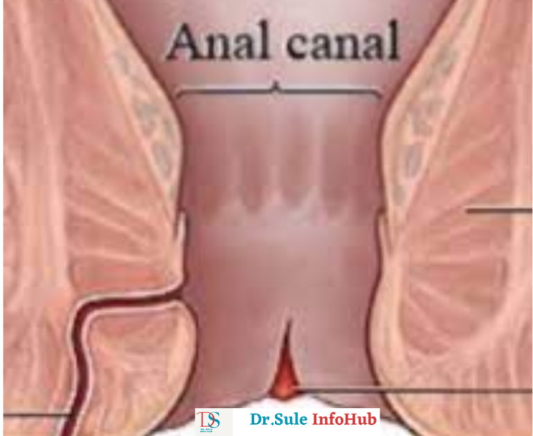 Home remedies for Anal Fissure