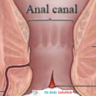 Home remedies for Anal Fissure